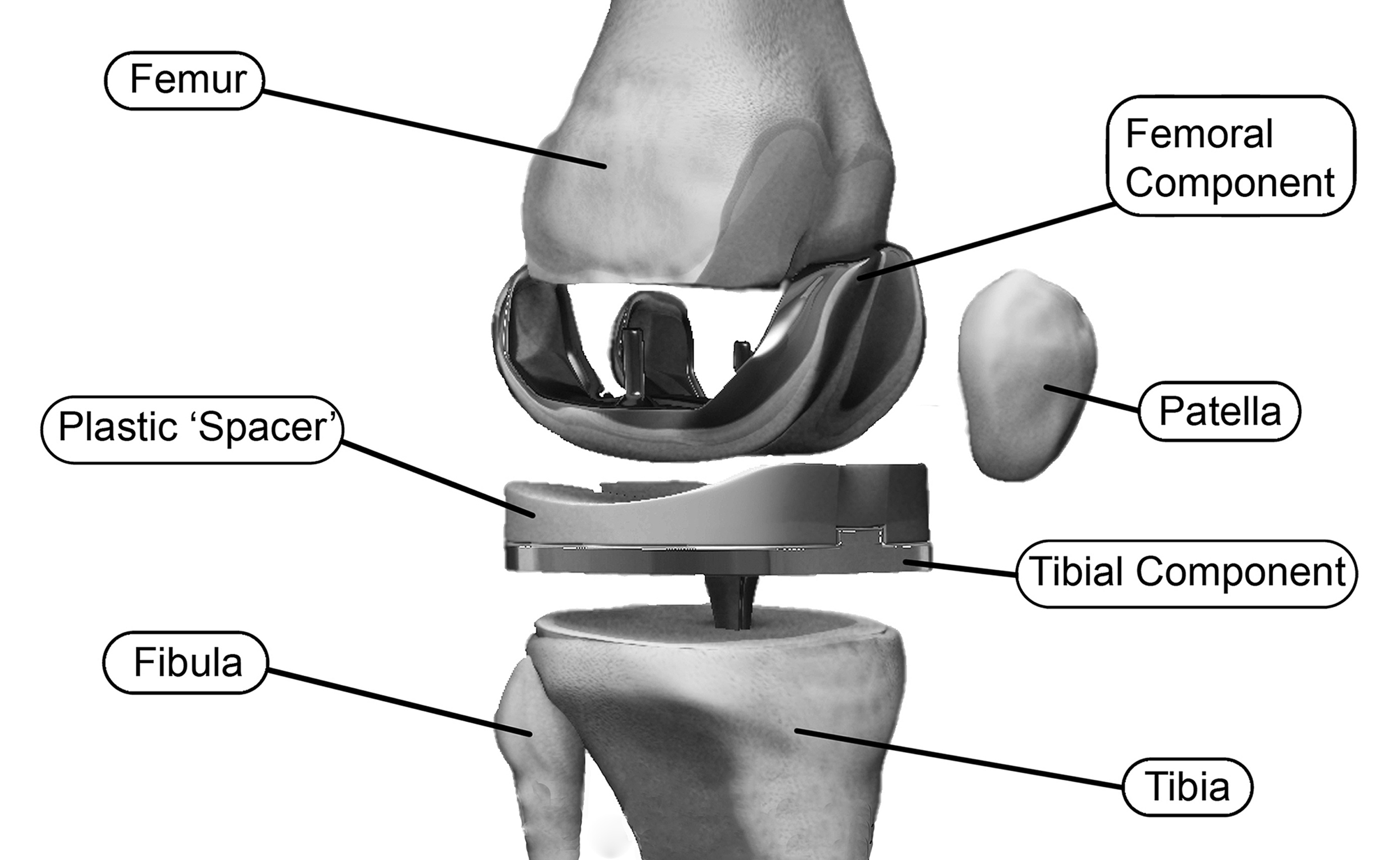 Expanded Blow-up of Knee Implant in Place